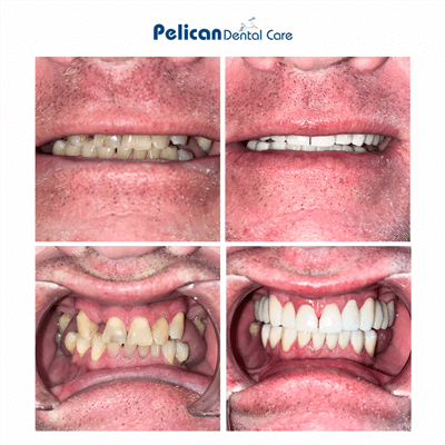 Before and after photo of a full mouth reconstruction for a patient with severe crowding and discoloration, Pelican Dental Care. Photo